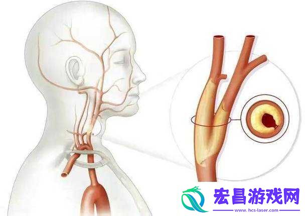 喷泉1V3阿司匹林所讲内容解析