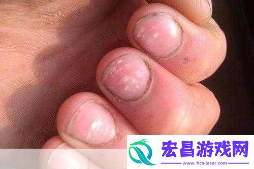 指甲上有竖纹在多数情况下是正常现象。随着年龄增长