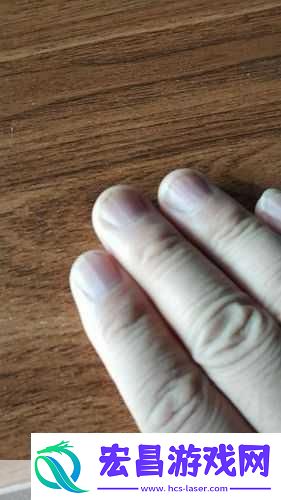 指甲上有竖纹在多数情况下是正常现象。随着年龄增长