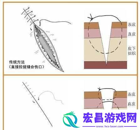竹板打肿臂缝合不上