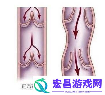 丝袜为什么可以防止静脉曲张