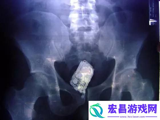 体内十年异物