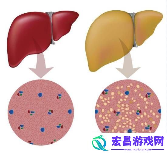大学生月瘦20斤却患上脂肪肝
