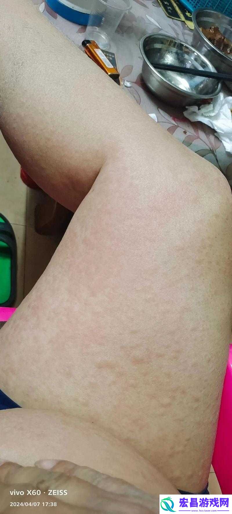 淑芬两腿中间又痒了引发的状况